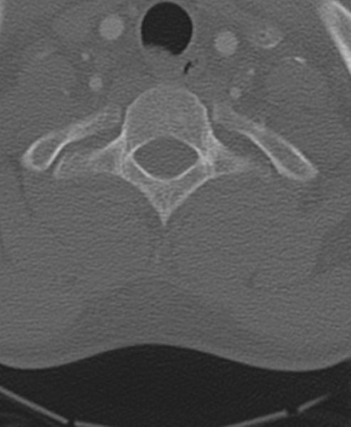 File:Normal CT thoracic spine (Radiopaedia 40181-42688 Axial bone window 10).png