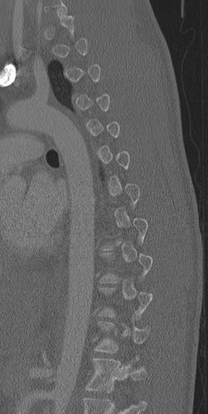 File:Normal CT thoracic spine (Radiopaedia 40181-42688 Sagittal bone window 22).png