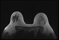 Normal breast MRI - dense breasts (Radiopaedia 80454-93850 Axial T1 160).jpg