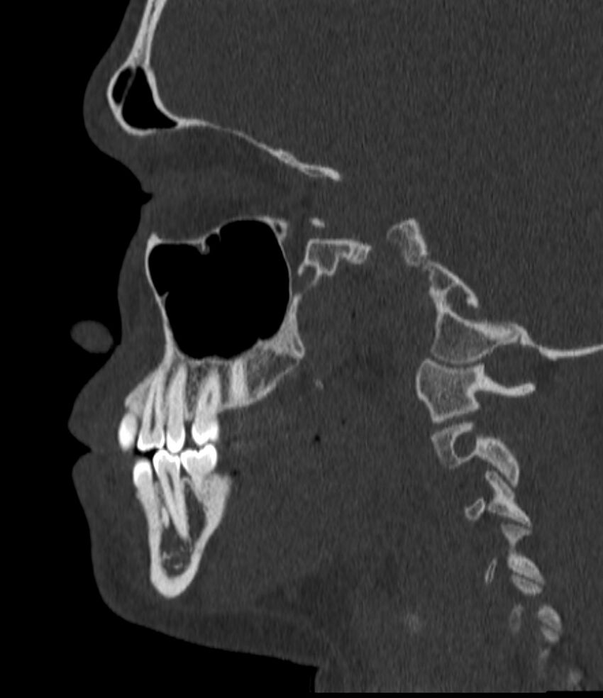 Normal facial bone CT (Radiopaedia 88742-105476 Sagittal bone window 68).jpg