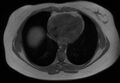 Normal liver MRI with Gadolinium (Radiopaedia 58913-66163 Axial T1 in-phase 32).jpg