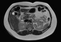 Normal liver MRI with Gadolinium (Radiopaedia 58913-66163 Axial T2 17).jpg