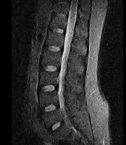 File:Normal lumbar spine MRI - low-field MRI scanner (Radiopaedia 40976-43699 Sagittal STIR 7).jpg