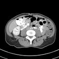 Normal multiphase CT liver (Radiopaedia 38026-39996 C 51).jpg
