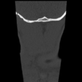 Normal trauma cervical spine (Radiopaedia 41017-43760 Coronal bone window 52).png