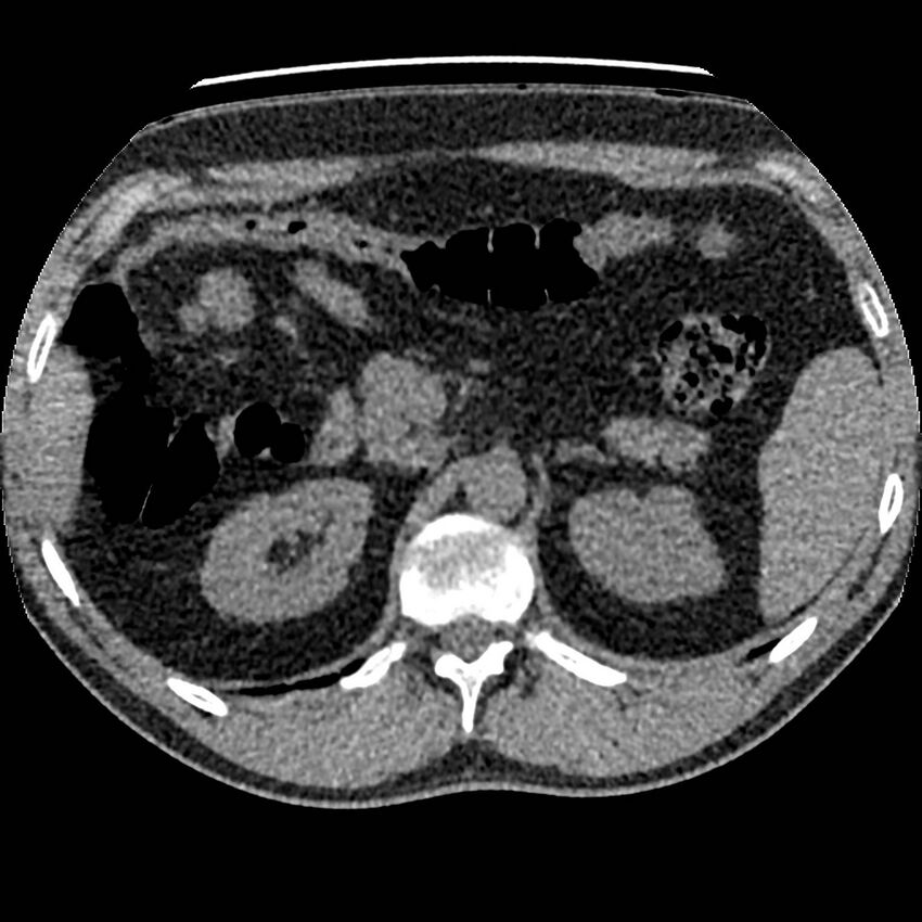 Obstructing ureteric calculus and ureteric anatomy (Radiopaedia 62730-71042 Axial non-contrast 20).jpg