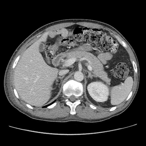 File:Obstructive bladder transitional cell carcinoma (Radiopaedia 9825-10410 A 5).jpg