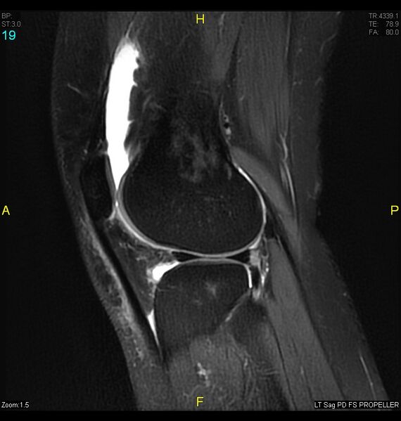 File:ACL mucoid degeration with cystic changes (Radiopaedia 48428-53341 Sagittal PD fat sat 17).jpg