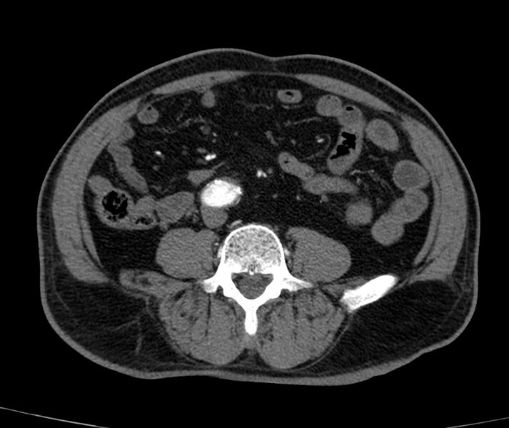 File:Abdominal aortic aneurysm (Radiopaedia 22421-22458 C+ arterial phase 56).jpg