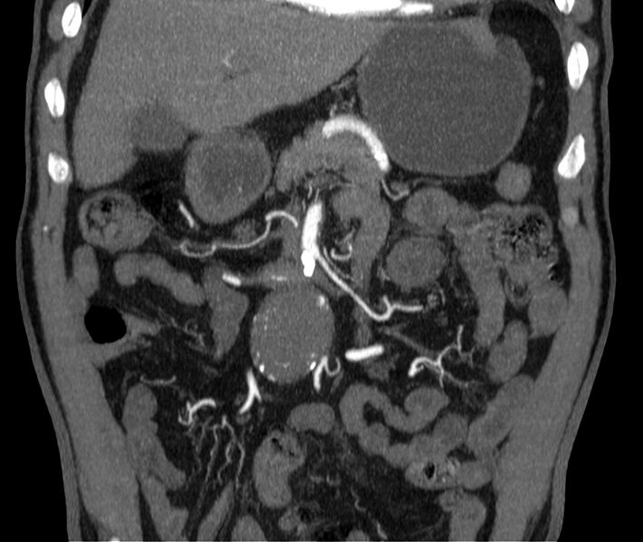 File:Abdominal aortic aneurysm (Radiopaedia 22421-22458 C 10).jpg