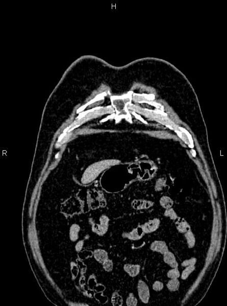 File:Abdominal aortic aneurysm (Radiopaedia 83094-97462 Coronal renal cortical phase 17).jpg