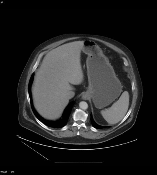 File:Abdominal aortic aneurysm with intramural hematoma then rupture (Radiopaedia 50278-55631 Axial C+ arterial phase 48).jpg