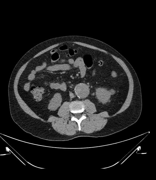 File:Abdominal aortic aneurysm with thrombus fissuration (Radiopaedia 46218-50618 Axial non-contrast 28).jpg