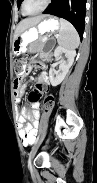 File:Abdominal wall and retroperitoneal tuberculosis (Radiopaedia 88137-104729 Sagittal C+ portal venous phase 51).jpg