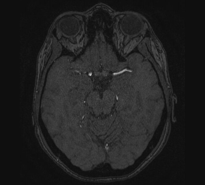 File:Accessory middle cerebral artery and ICA aneurysm (Radiopaedia 22656-22674 MRA 46).jpg