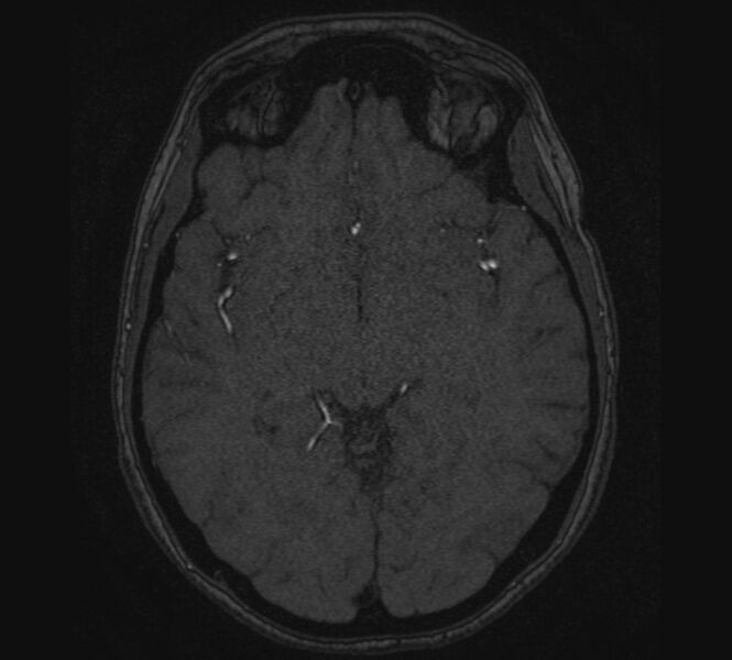 File:Accessory middle cerebral artery and ICA aneurysm (Radiopaedia 22656-22674 MRA 65).jpg