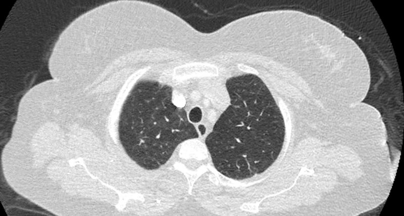 File:Accessory right inferior hepatic vein (Radiopaedia 65245-74259 Axial lung window 8).jpg