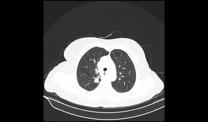 File:Acquired tracheo-esophageal fistula (Radiopaedia 51356-57103 Axial lung window 13).jpg