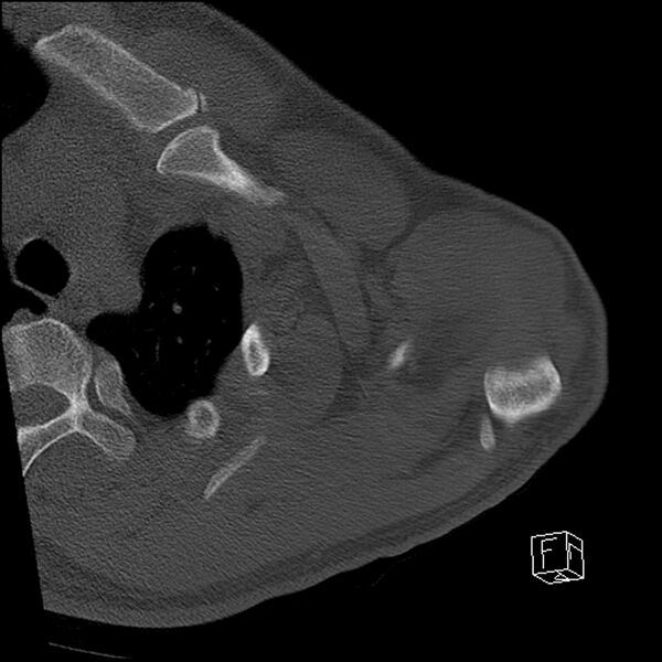 File:Acromioclavicular joint dissociation - type IV (Radiopaedia 64411-73216 Axial bone window 13).jpg
