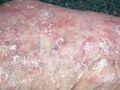 Actinic keratoses affecting the legs and feet (DermNet NZ lesions-ak-legs-476).jpg