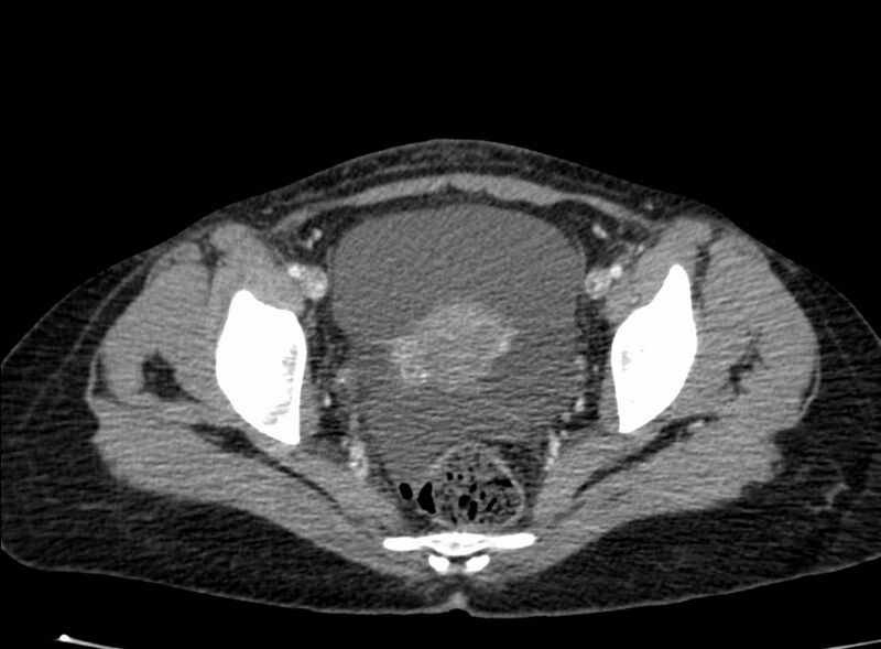 File:Acute Budd-Chiari syndrome (Radiopaedia 60858-68638 Axial C+ portal venous phase 268).jpg