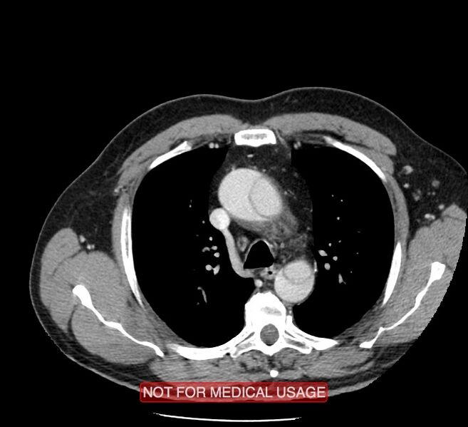 File:Acute aortic dissection - Stanford type A (Radiopaedia 40661-43285 Axial C+ portal venous phase 10).jpg