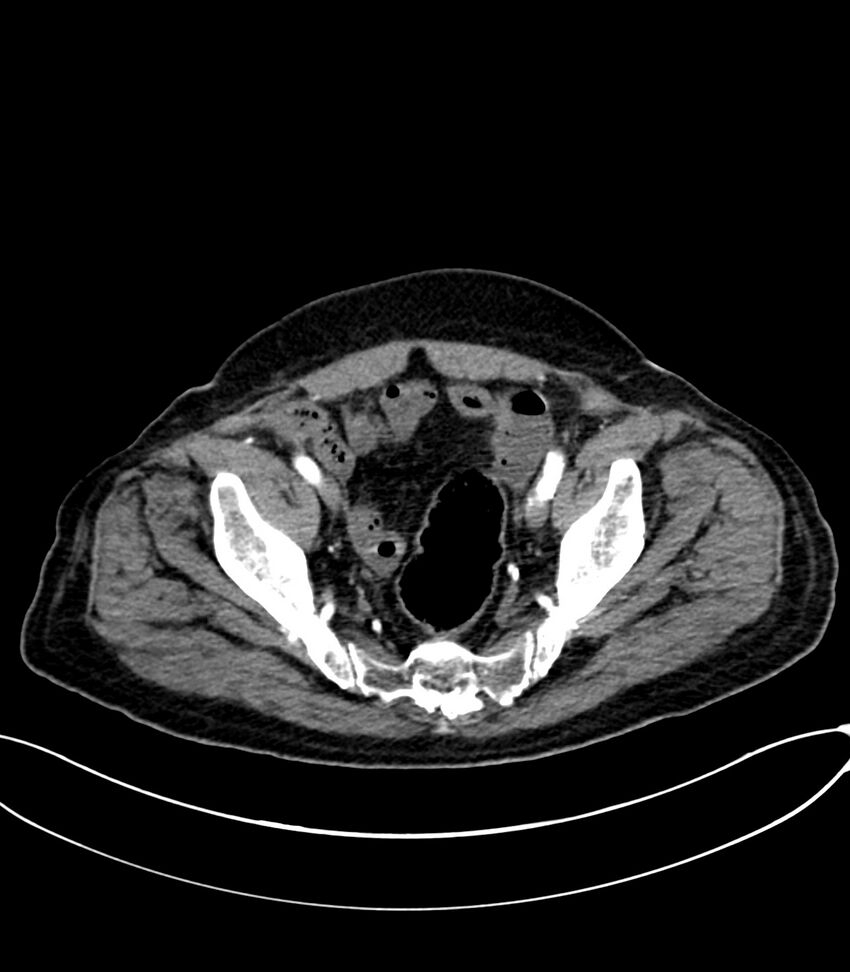 Acute arterial mesenteric ischemia (Radiopaedia 78238-90828 Axial C+ arterial phase 121).jpg