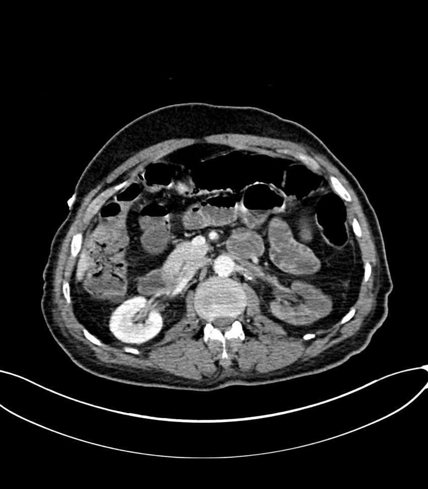 Acute arterial mesenteric ischemia (Radiopaedia 78238-90828 Axial C+ portal venous phase 55).jpg