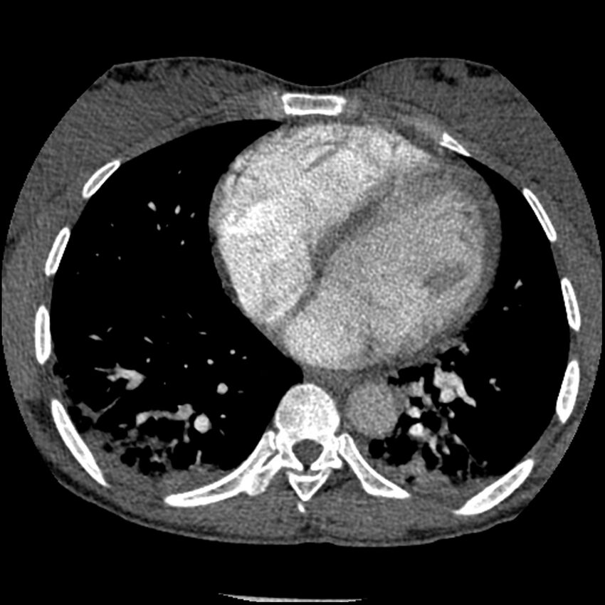 Acute chest syndrome - sickle cell disease (Radiopaedia 42375-45499 Axial C+ CTPA 123).jpg