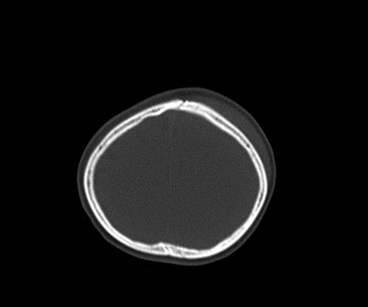 File:Acute epidural hematoma (Radiopaedia 63659-72335 Axial bone window 30).jpg