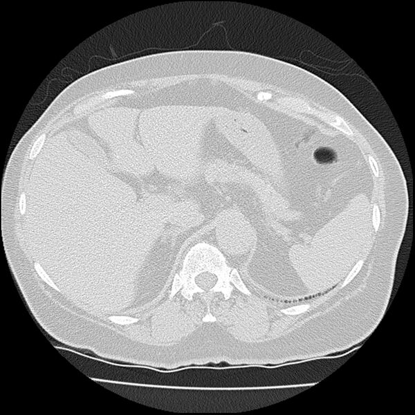 File:Acute interstitial pneumonitis (Radiopaedia 45404-49452 Axial lung window 91).jpg