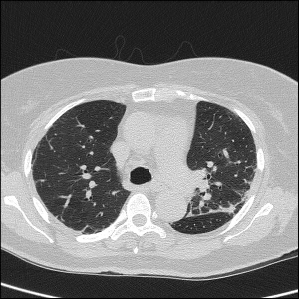 File:Acute interstitial pneumonitis (Radiopaedia 45404-49453 Axial lung window 32).jpg