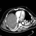 Acute pancreatic necrosis (Radiopaedia 13560-13486 Axial C+ portal venous phase 15).jpg