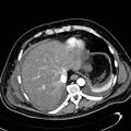 Acute pancreatic necrosis (Radiopaedia 13560-13486 Axial C+ portal venous phase 25).jpg