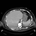 Acute pancreatic necrosis (Radiopaedia 13560-18503 Axial C+ portal venous phase 12).jpg