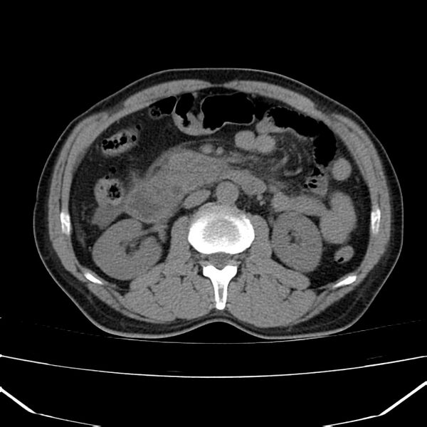 File:Acute pancreatitis (Radiopaedia 22572-22596 Axial non-contrast 28).jpg