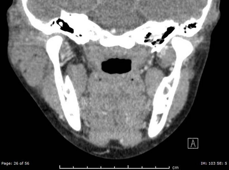 File:Acute parotitis (Radiopaedia 54123-60294 Coronal C+ arterial phase 5).jpg