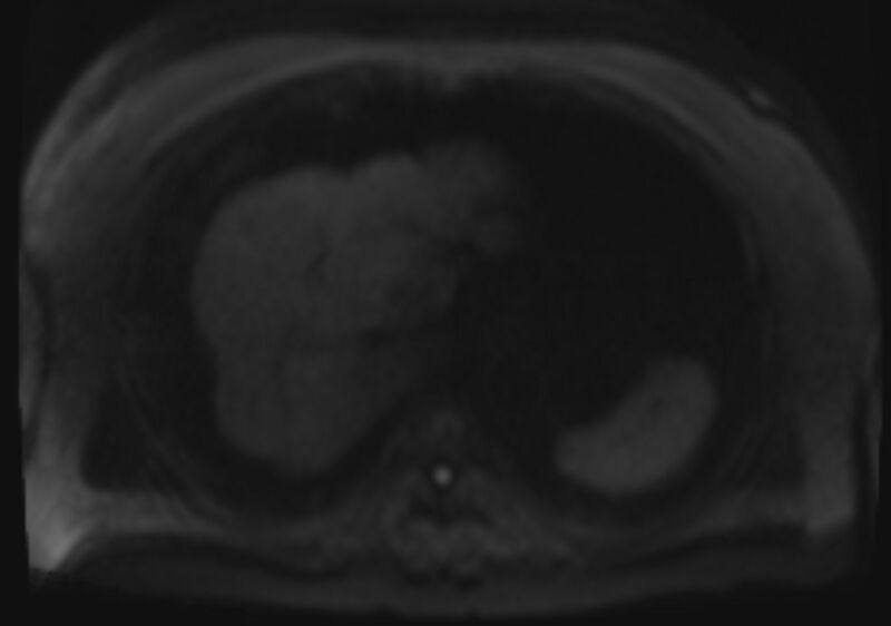 File:Acute portal vein thrombosis (Radiopaedia 73198-83925 Axial DWI 68).jpg