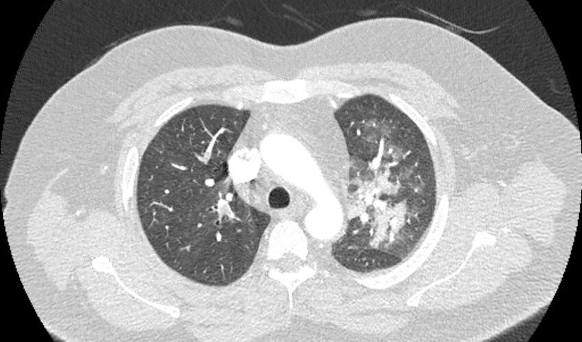 Acute pulmonary embolism with pulmonary infarcts (Radiopaedia 77688-89908 Axial lung window 28).jpg