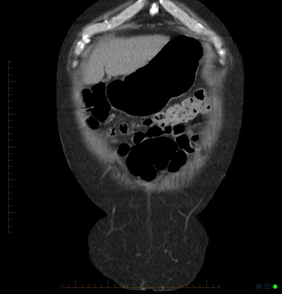 File:Acute renal failure post IV contrast injection- CT findings (Radiopaedia 47815-52557 Coronal non-contrast 2).jpg