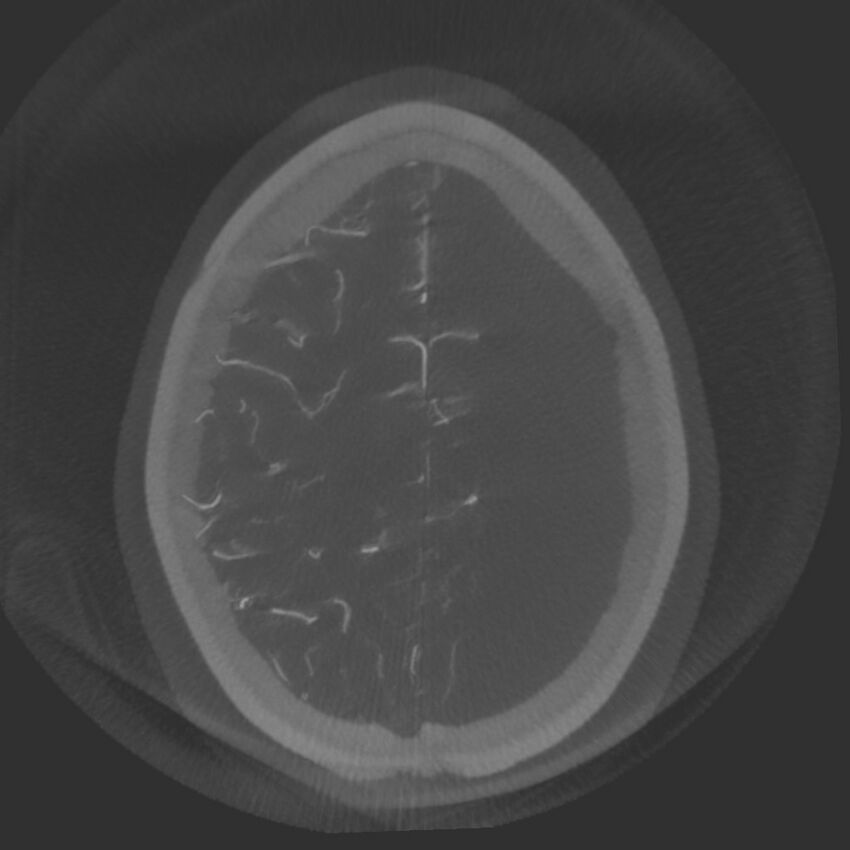 Acute subarachnoid hemorrhage and accessory anterior cerebral artery (Radiopaedia 69231-79010 Axial arterial - MIP 70).jpg