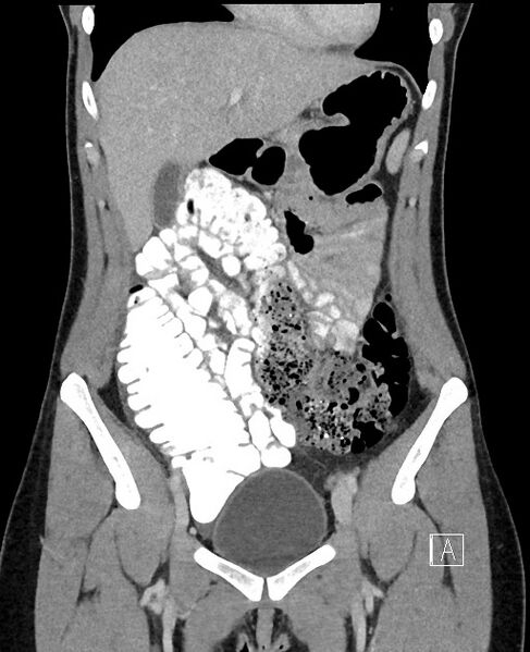 File:Acute uncomplicated appendicitis (Radiopaedia 61374-69304 Coronal C+ portal venous phase 32).jpg
