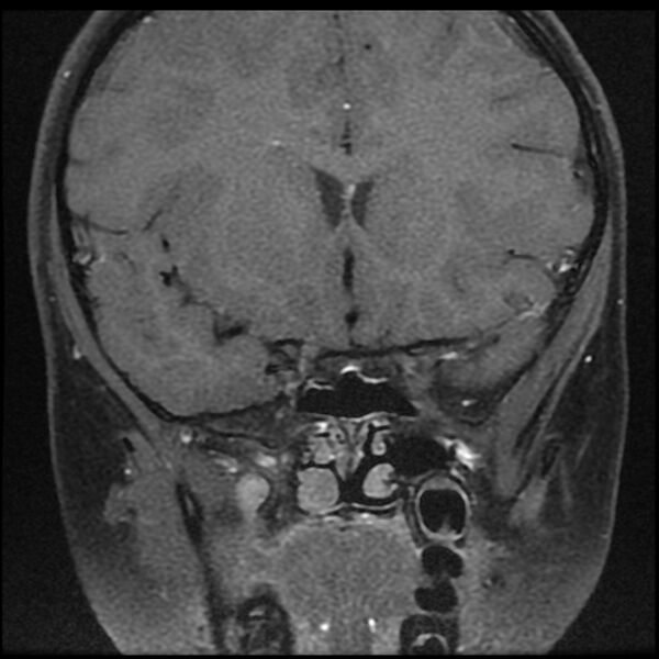 File:Adamantinomatous craniopharyngioma (Radiopaedia 77407-89529 Coronal T1 C+ fat sat 1).jpg