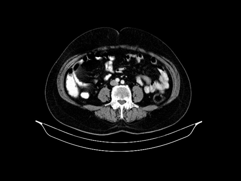 File:Adenocarcinoma of pancreas with hepatic metastasis (Radiopaedia 64332-73122 Axial C+ portal venous phase 63).jpg
