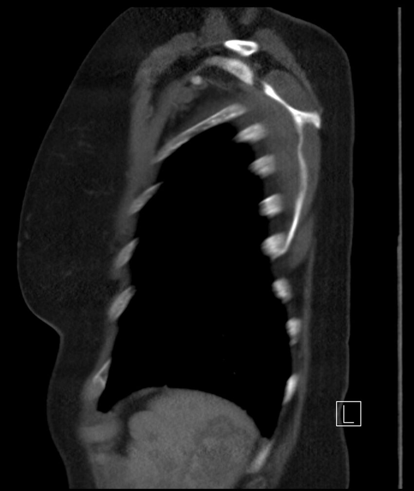Adenocarcinoma of the lung (Radiopaedia 44205-47803 Sagittal C+ portal venous phase 7).jpg