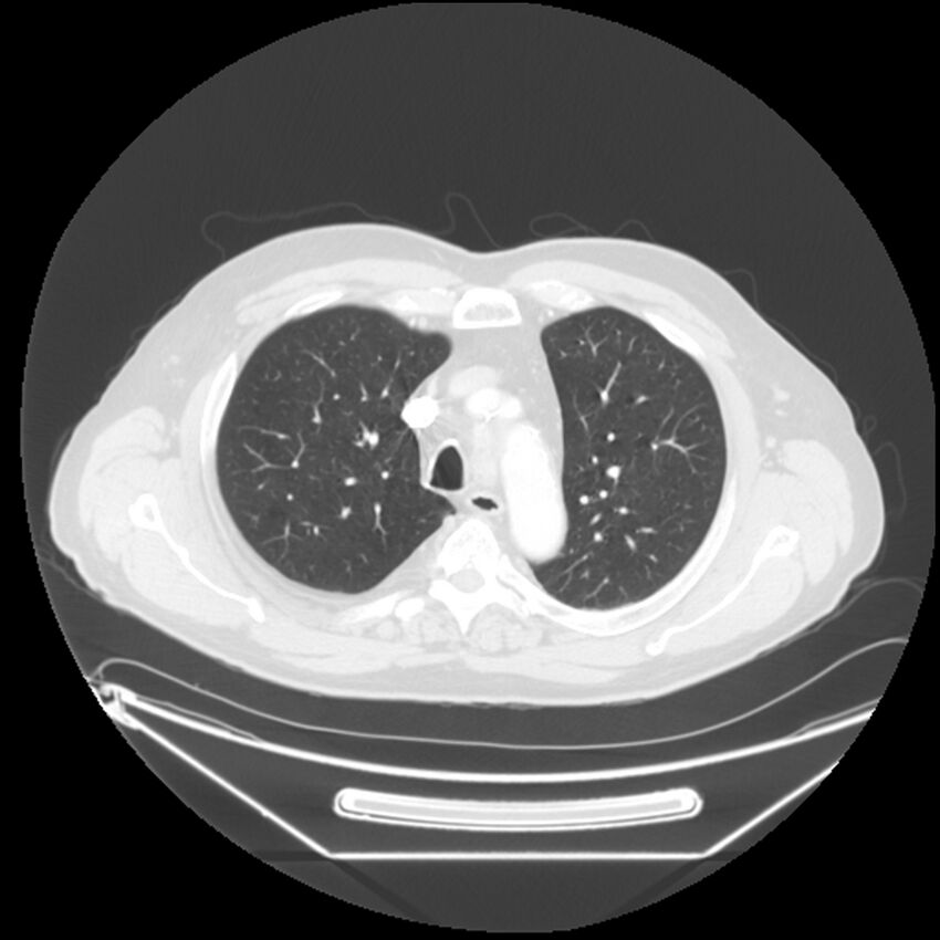 Adenocarcinoma of the lung (Radiopaedia 44876-48759 Axial lung window 20).jpg