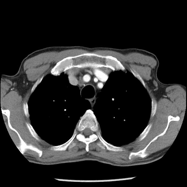 File:Adenocarcinoma of the lung - micropapillary predominant (Radiopaedia 42446-45563 Axial C+ portal venous phase 15).jpg
