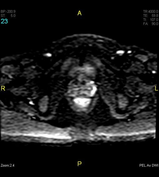 File:Adenomyosis (Radiopaedia 43504-46889 Axial DWI 23).jpg