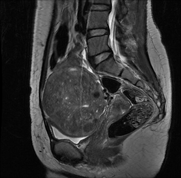 File:Adenomyosis on MRI (Radiopaedia 29328-29780 Sagittal T2 7).jpg