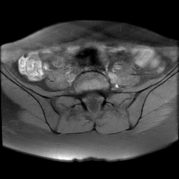 File:Adenomyosis within a septate uterus (Radiopaedia 69963-79981 Axial T1 fat sat 5).jpg